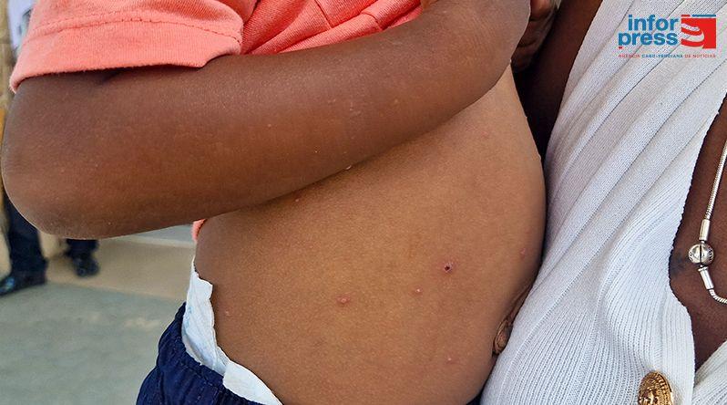 Boa Vista: Surto de Varicela e Alerta para Mão-Pé-Boca