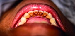 Fluorose dentária na Brava: um problema de gerações que ganha finalmente uma resposta