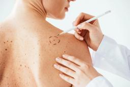 Farmacêuticas anunciam resultados positivos para vacina contra melanoma