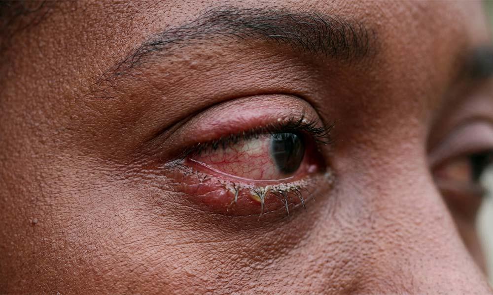 Sal com surto de conjuntivite: Delegacia de Saúde recomenda medidas de prevenção