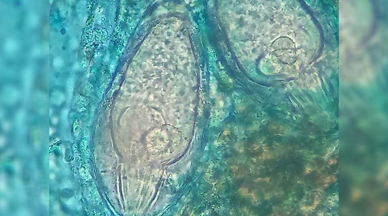 Saúde: Cientista confirma casos de esquistossomose na Praia e admite mais pessoas infectadas